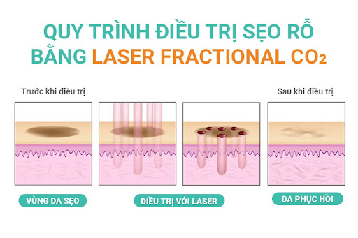 điều trị sẹo rỗ bằng laser,trị sẹo rỗ laser,trị sẹo rỗ bằng laser có hiệu quả không,giá điều trị sẹo rỗ bằng laser,điều trị sẹo rỗ bằng laser co2,điều trị sẹo rỗ bằng laser fractional co2,có nên điều trị sẹo rỗ bằng laser co2
